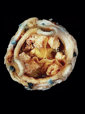 A bioprosthetic porcine valve with calcifications