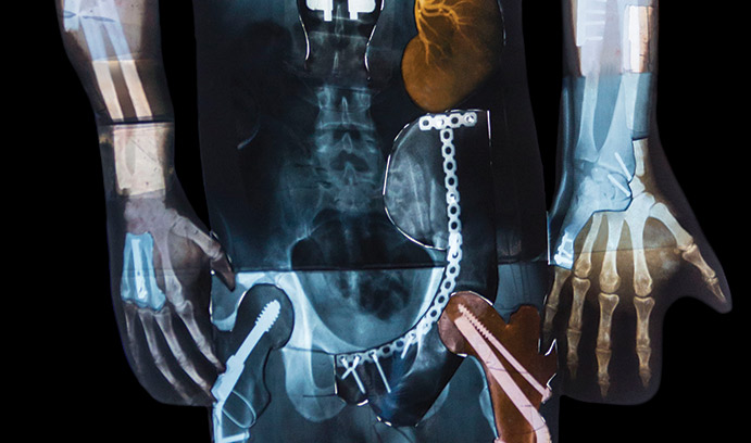 Lehigh_Univeristy_Research_Review_2017_Main_HealingBoneFaster