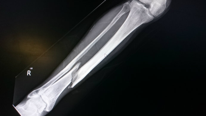 bone_fracture_